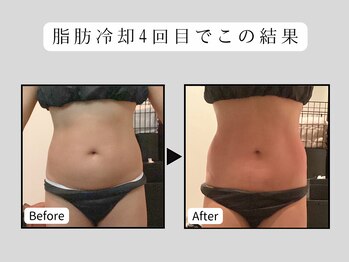 クローネ(Krone)/脂肪冷却ビフォーアフター