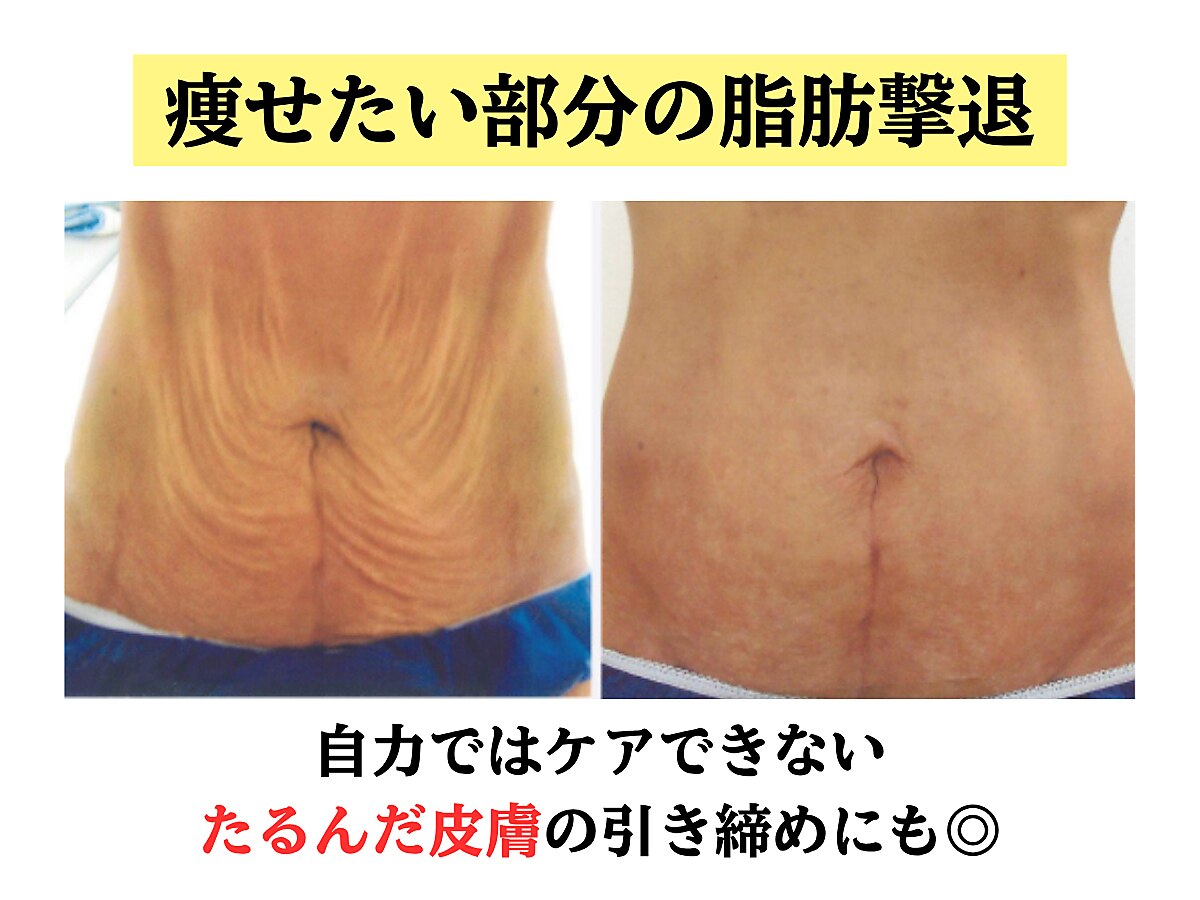 堺筋本町駅でキャビテーションが人気のエステサロン｜ホットペッパー