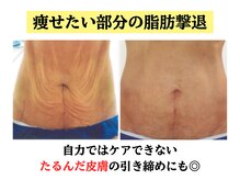 セレブリボーン 大阪ボーテ