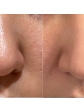 サロンジー(Salon Gee)/イチゴ鼻になっていませんか？