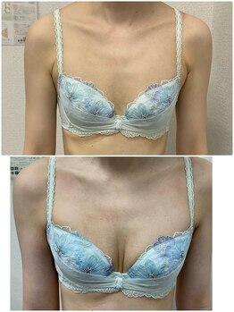 バーディー(BIRDIE)/施術3カ月/3０代/AAA→C