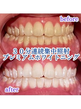 プラスビーセルフ(+b self)/30分連続照射*ホワイトニング
