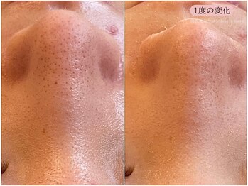 レスイズモア 恵比寿(less is more.)/１度の変化［ピーリングのみ］