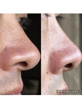 セルフダック いわき平店(SELFDUCK)/◇セルフハイドラの症例写真2