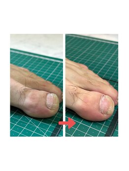 ナカザワ(NAKAZAWA)/根本解決できれいな爪に