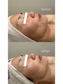 ウィール 栄 矢場町店(WE:LL)/小顔美肌フェイシャル