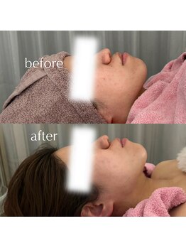 アルバ スキンガーデン(ALBAスキンガーデン)/before・after〈20代〉