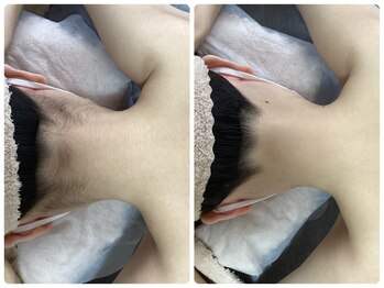 ルルトウキョウ 池袋店(LULU.tokyo)/うなじ脱毛