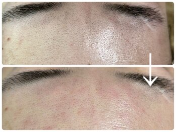 ニコ(Nico)/毛穴エクストラクション