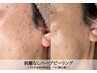 人気NO1国産ピーリング【ニキビ毛穴ケア】お顔ハーブピーリング¥16500→¥5500