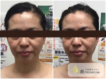 美プレミアム 越谷店/360°美顔小顔矯正｜施術結果
