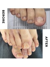 リミズネイルビューティー 名駅店(RimisNailxbeauty)/【美爪育成】《フット》深爪改善