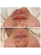 プランス 恵比寿店(PLANCE)/顎のニキビケア