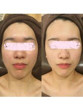 アユアランリンク 札幌店/20代後半/約5ヵ月/フェイシャル