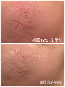 エステティックサロン ベルエトワール住吉店/凸凹肌も毛穴洗浄で◎