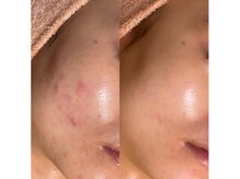 シャルナ(charna)の雰囲気(鏡を見るたび嬉しくなる。肌トラブルに悩まない透明美肌へ)