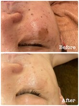 ミラ(Mila)/お肌改善　　before after