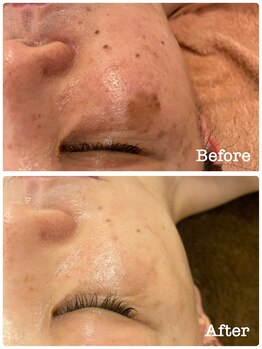 ミラ(Mila)/お肌改善 before after