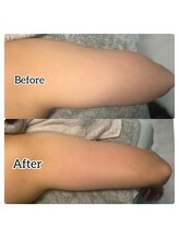 トータルビューティーアンドウィズ(total beauty&WITH)/蓄熱式超音波ボディ二の腕