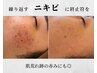 【ニキビケア：跡赤み◎】★プラズマシャワ-(全顔3周照射)＋VC波導入￥13800