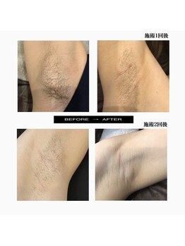 タグ 高知駅前店(Tug)/脱毛