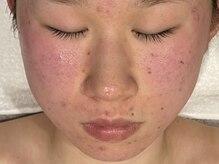 オアシスラグーン(OASIS LAGOON)/ニキビケア（症例４：before）