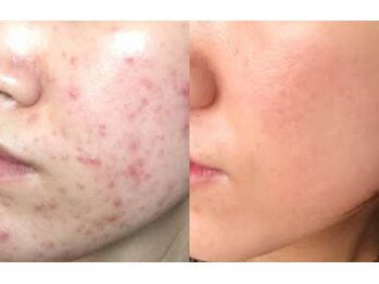 キラベル 平塚店(KiraBelle)/ 平塚/陶肌ハーブ14回で美肌へ