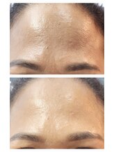 トリアングル(TLIENGLE)/ララピール　before　after