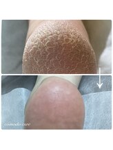 コモドキュア 札幌店/重度の角質ケア