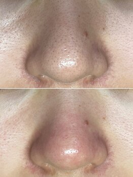 しらゆき 名古屋黒川/毛穴エクストラクション