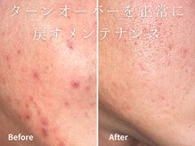 グレース 吉祥寺(grace)/毛穴ケア BeforeAfter