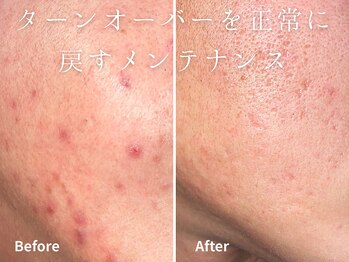 グレース 吉祥寺(grace)/毛穴ケア BeforeAfter