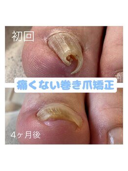 ロッティ(Lottie)/巻爪矯正