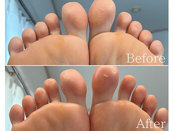 カシェット 広島店(Cachette)/30代女性☆足裏角質ケア90分