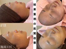 お肌に合わせてオーダーメイド施術