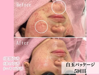 エン クリニカルラボ 心斎橋店(E&N CLINICAL LABO)/白玉パッケージ☆