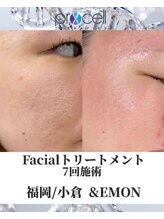 アンドエモン(&EMON)/【お顔】プロセル効果
