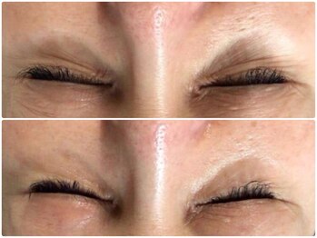 ミロク(369)/Before&After プラズマ