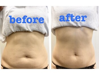 ラウレア 松山店(LAULEA)/ぽっこりお腹にくびれを作る