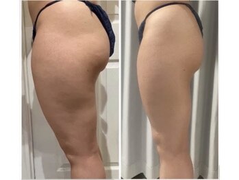 カレン(KAREN)/脂肪燃焼&セルゼロ#太もも