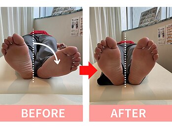 北浦和整体院/産後のO脚やX脚、大転子のハリに