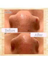 ウィズリリナ 新横浜(with Lilina.)/1回/毛穴洗浄/ハイドラ/新横浜