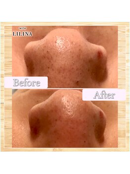 ウィズリリナ 新横浜(with Lilina.)/1回/毛穴洗浄/ハイドラ/新横浜