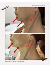 ユーフォリア(Euphoria)/フェイスライン、首、あごの下