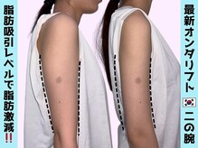 オンダリフト東京　大阪梅田店【韓国肌管理】オンダリフト/ララ ピール/小顔矯正/痩身/オンダリフト/梅田/ララピール