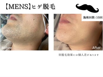 ゴールド(GOLD)/ヒゲ脱毛Before→After