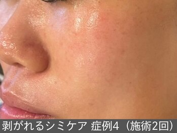 オアシスラグーン(OASIS LAGOON)/シミケア(症例4 施術2回)30代