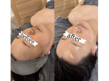 クラン(CLAN)の写真/【海外セレブも愛用！ダーマロジカのピーリングorレチノールトリートメント♪毛穴レスなハリツヤ肌に。