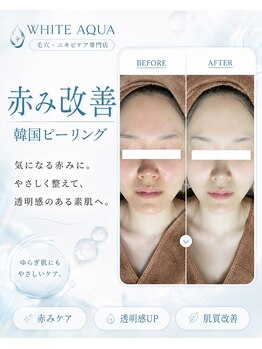 ホワイトアクア 北堀江店(WHITE AQUA)/赤み改善