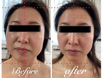 美バストアルファ(美bust α)/【小顔コルギ】症例